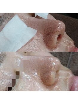 ボーソリューション(Beau-Solution)/【20代　開き毛穴/黒ずみ毛穴】