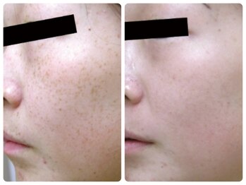 スイ 昭島店(Sui)/ホワイトスノーピール/シミ/美白