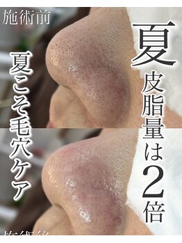 ロカヒ(Lokahi)/毛穴改善コース