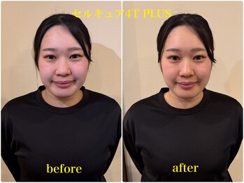 コリニック 香椎店/セルキュア4tPLUS