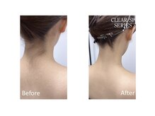 ニコ(nico)/綺麗なうなじで女子力アップ！