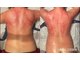 エクラ(eclat)の写真/その肩こり,もう悩まないで!【No,1人気★スライド式カッピング20分 3,500円体験】その場で驚くほど血流改善