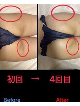 美尻研究所 福岡大名店/横の凹み改善！