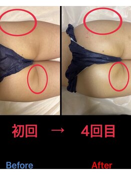 美尻研究所 福岡大名店/横の凹み改善!