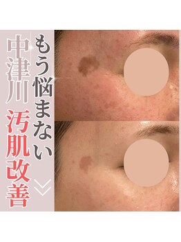 ホワイトニングジム アイス/エステでもシミにアプローチ!