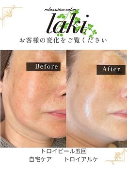 リラクゼーションサロン ラキ(laki)/トロイピール