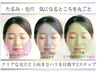 【ハイドラ・RF・ポレーション】3つの施術いいとこ取りお顔を整えるコース