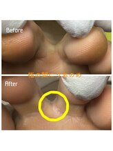 プラスキュア 用賀店(+CURE)/タコうおのめケア60分￥6600～