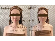 ラ フルール(La Fleur)/小顔矯正コルギ　before→after