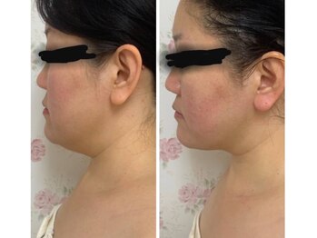 クイーン 熱海店(Queen)/1回でこのスッキリ感!