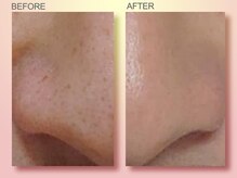 ジュリア オージェ 難波店/ビフォーアフター（鼻スパ）