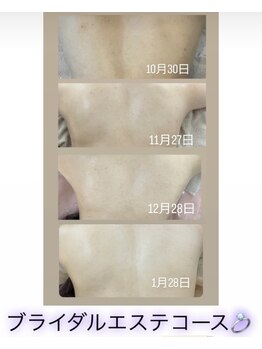 アールエム ボーテ(RM beaute')/背中ハーブピーリング