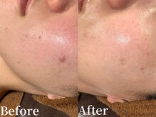 プレジール(plasir)/ニキビケアお任せ下さい！