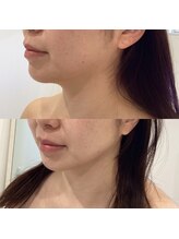 ビューティーサロン セガール(segar)/レモンボトルフェイス