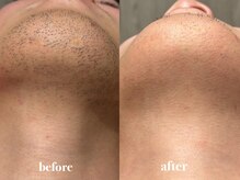 ナーズプラス リベルテ(Naz Plus/Liberte)/メンズ顔脱毛