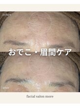 ヨサ モア(yosa more)/【60代毛穴・シワ】BeforeAfter