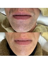 ビビ/ヒゲ脱毛/メンズ脱毛/髭脱毛