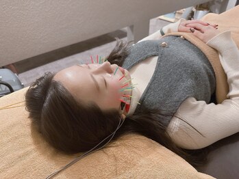 鍼灸整骨ミヤビ 札幌八軒(鍼灸整骨MIYABI)の写真/電気を流してお顔を動かす美容鍼◎年間1000人以上のお客様の美容をサポート!本物の美容鍼はMIYABIで◎