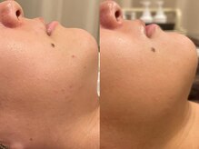 ハーブのほし/ニキビケア/跡/赤みの改善