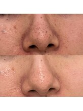 ホワイトニングジム アイス/毛穴でもう悩まない！毛穴洗浄