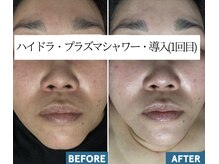 いやされサロン フー(fuu+)の雰囲気（ハイドラ&話題のプラズマシャワー導入☆一回施術でこの効果!）