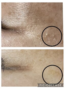 フリージア(Beauty Salon Freesia )/美肌菌活ピールで稗粒腫改善