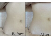 プランドール 京都店(PRENDRE)/お腹　施術１回目→５回目