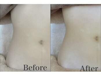 プランドール 京都店(PRENDRE)/お腹 施術1回目→5回目