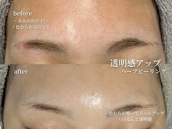 コウル 川西能勢口店(geoul)/毛穴レス美肌コース4回