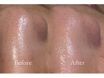 ファミーユ 太田(Fameu)/毛穴洗浄、フェイシャルワックス