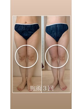 リノ(Lino)/むくみ撃退！美脚ライン