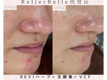 ルリエベル(Relier Belle)/REVIハーブピーリング★1回