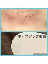 ウルル(Ululu)/【メンズ脱毛】ポンポン飛び出す