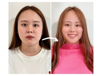 エピファニー 東京 銀座/ビフォーアフター(M様 20代)