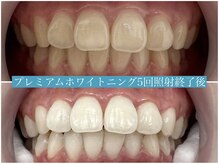 歯のホワイトニング 岐阜アクティブG店/プレミアムホワイトニング施術☆