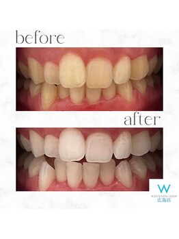 ホワイトニングショップ 広島店(WHITENING SHOP)/【ホワイトニング】Before After