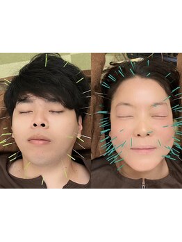 鍼灸施術を受けたい