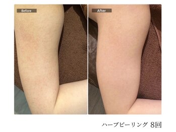 エミルカ 宮崎店(EMILUCA)/【クーポン有】二の腕症例