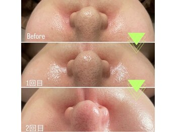 マロン(MARON)/艶肌ラミネーションピール