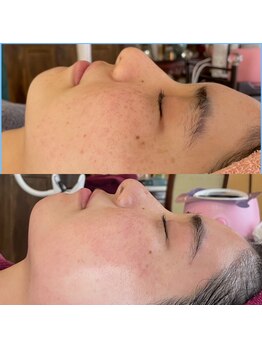 ワッカ(wacca)/【ヒト幹細胞】ビフォーアフター