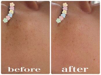 パール(PEARL)/施術前後目の下のシミが…♪