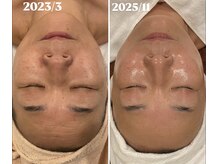 トータルエステティック ジョワイユ(JOYEUX)/両方施術前に撮影です！別人級！