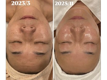 トータルエステティック ジョワイユ(JOYEUX)/両方施術前に撮影です！別人級！