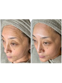 ホウレイ線・たるみ改善！予防ケア