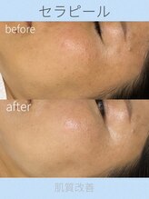 カピリナスパ(Ka.Pilina Spa) セラ ピール