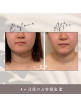 ヨサパーク すずのね(YOSA PARK)/３ヶ月後の効果で小顔に◎