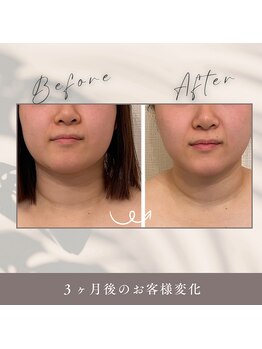 ヨサパーク すずのね(YOSA PARK)/３ヶ月後の効果で小顔に◎