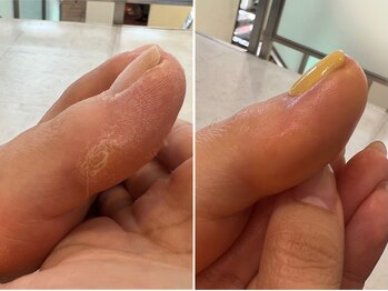 硬いタコもスッキリ！