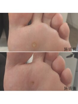 なかやまネイルクリニック/魚の目