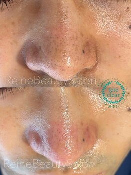 レーヌ(Reine)/毛穴エクストラクション